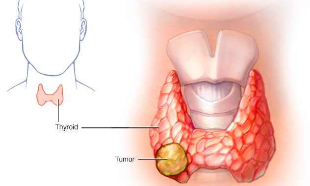 ds00492_im03899_c7_thyroidcancerthu_jpg