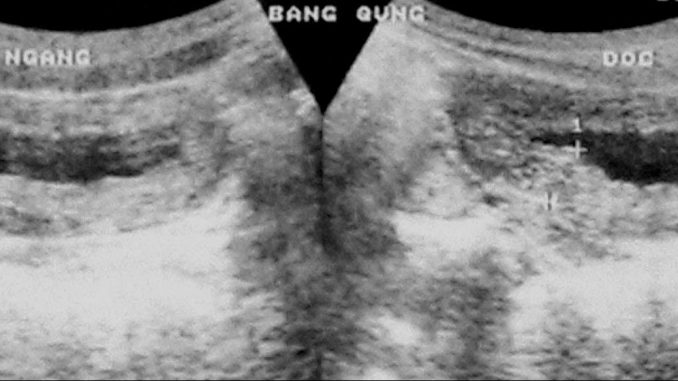 Viêm bàng quang trên siêu âm