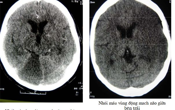 nhồi máu não 07