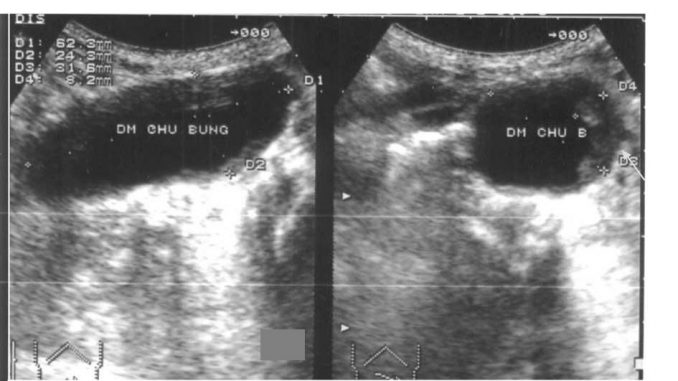 siêu âm động mạch chủ tĩnh mạch chủ dưới 5