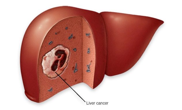 Ung thư gan - Source: mayoclinic