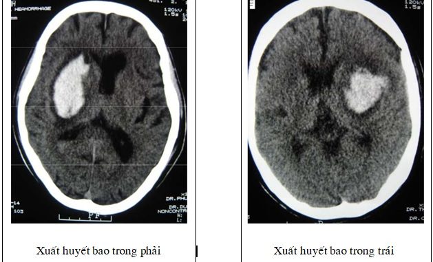 xuất huyết não tbmn 04