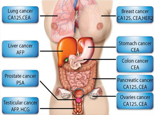 Bộ xét nghiệm dấu ấn sinh học (marker) của 15 loại ung thư thường gặp