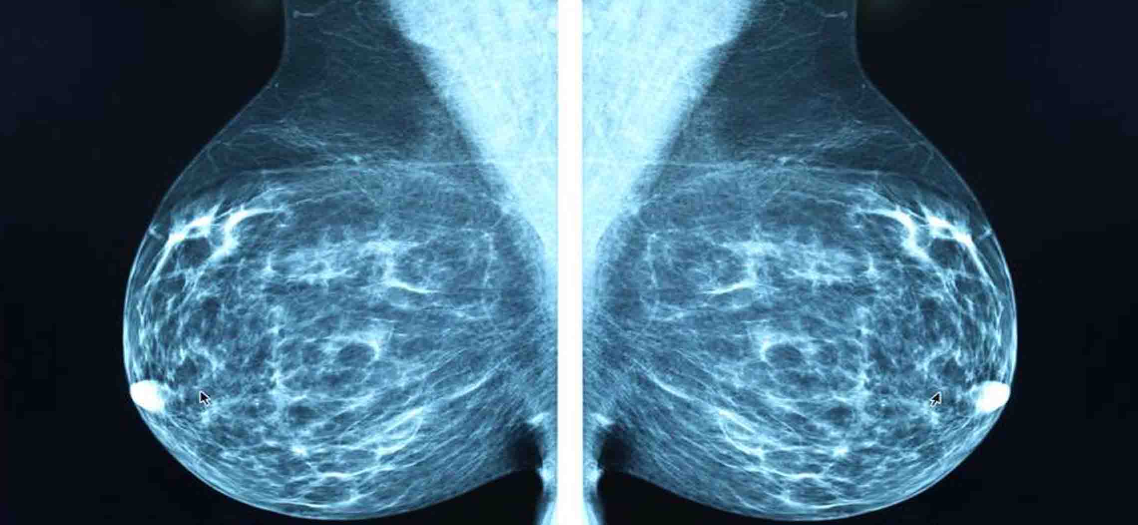 CDC – X-quang tuyến vú (Nhũ ảnh – Mammography)