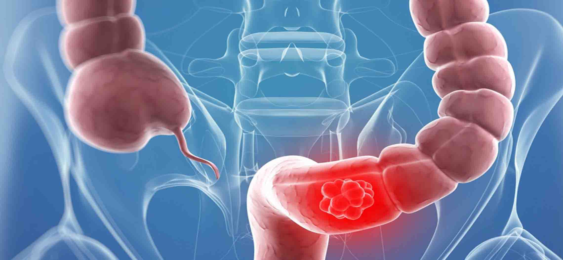 CEA – dấu ấn ung thư đại trực tràng