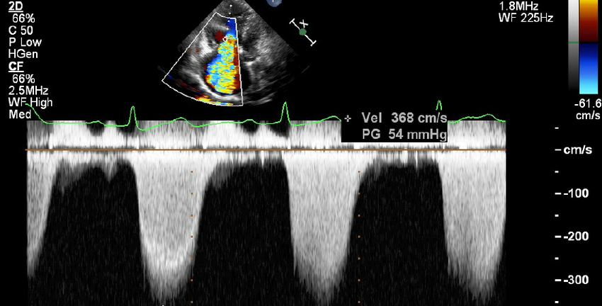 Khuyến cáo của hội tim mạch Châu Âu về đánh giá mức độ hở van ba lá trên siêu âm tim Doppler màu