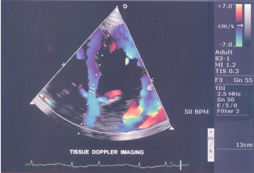 [PDF] Sách siêu âm tim từ cơ bản đến nâng cao bản đẹp – PGS. Nguyễn Anh Vũ