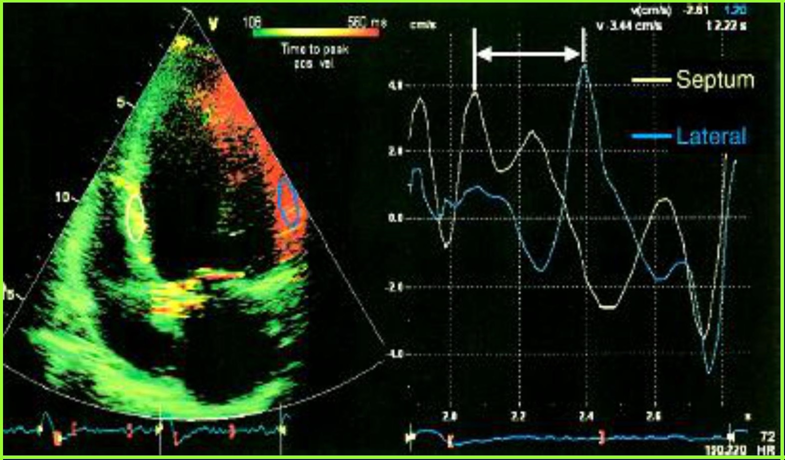 [Hội nghị tim mạch VIII] Siêu âm Doppler tim đánh giá chức năng tâm thu thất trái – Bs. Nguyễn Tuấn Hải viện tim Bạch Mai