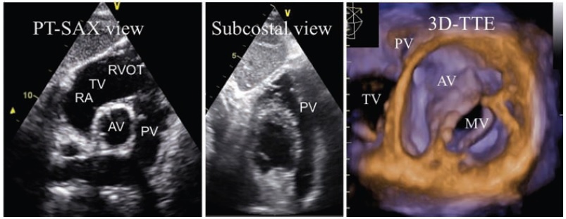 [PDF] Recommendations for the echocardiographic assessment of native valvular regurgitation – Khuyến cáo về đánh giá mức độ hở tất cả các van tim trên siêu âm tim Doppler màu.