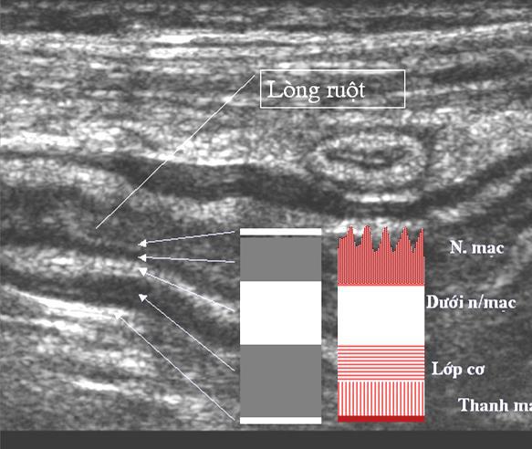 Siêu âm ống tiêu hóa – GS. Phạm Minh Thông Bạch Mai – viRAD