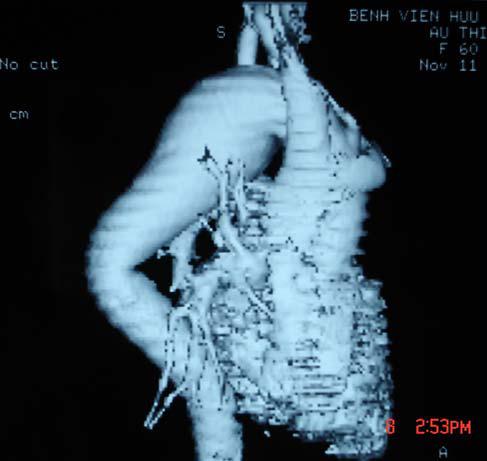 Hình ảnh và một số bệnh động mạch chủ trên phim chụp cắt lớp vi tính