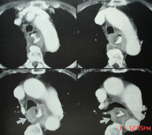 Hình ảnh và một số bệnh lý tim và trung thất trên chụp cắt lớp vi tính lồng ngực