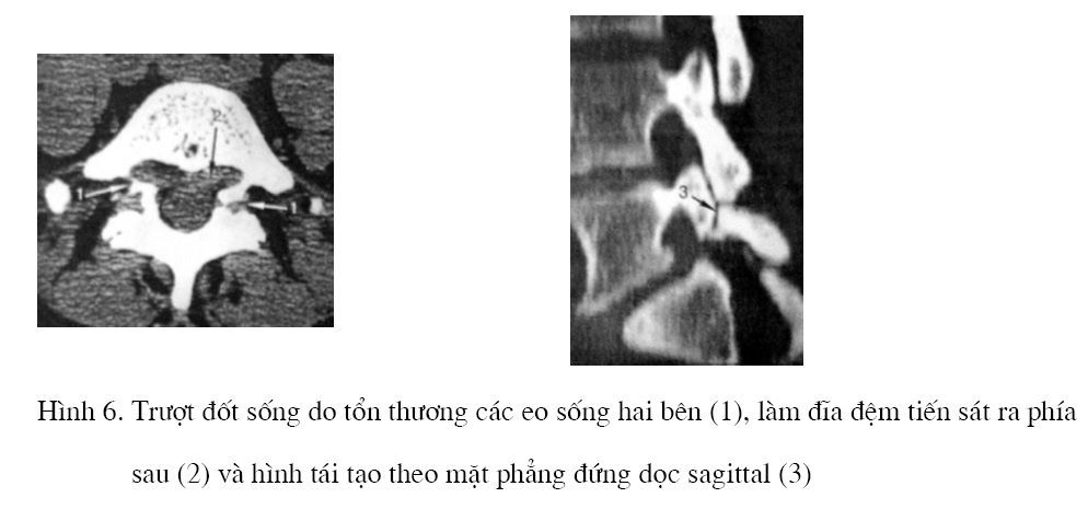 [Bạch Mai] Chụp cắt lớp vi tính trong bệnh lý thoái hóa cột sống – ThS. Bs. Phạm Đức Hiệp, BV Hữu Nghị Việt Đức