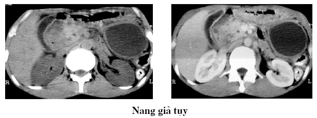 Bạch Mai] Chụp cắt lớp vi tính bệnh viêm tụy cấp – viRAD