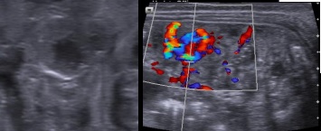 [VSUM2019] Dị dạng động tĩnh mạch ruột hỗng tràng gây xuất huyết tiêu hóa dưới ở trẻ sơ sinh