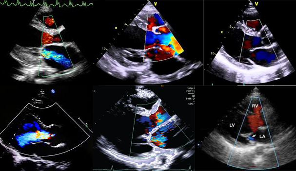 Lát cắt siêu âm tim cơ bản và hình minh họa