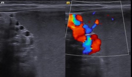 [VSUM2019] Huyết tắc tĩnh mạch lách được chẩn đoán bằng siêu âm Doppler màu và phẫu thuật bắc cầu lách – mạc treo
