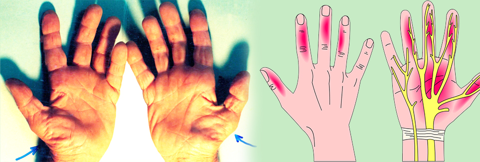 Hội chứng ống cổ tay: đau hoặc rối loạn cảm giác ở tay xin đừng chủ quan