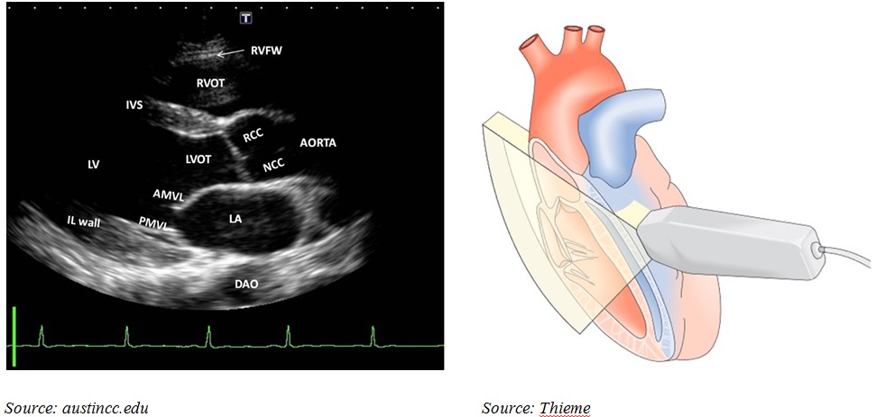 lát cắt trục dài cạnh ức siêu âm tim