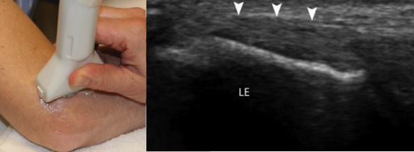[VSUM2019] Bệnh lý gân điểm bám trên lồi cầu xương cánh tay – Siêu âm chẩn đoán và hướng dẫn can thiệp điều trị