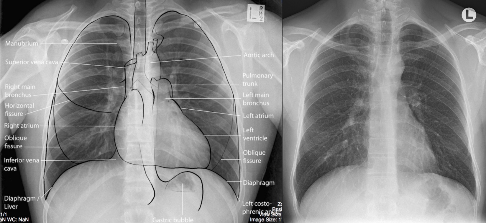 XQuang tim phổi và kiến thức bước đầu – viRAD
