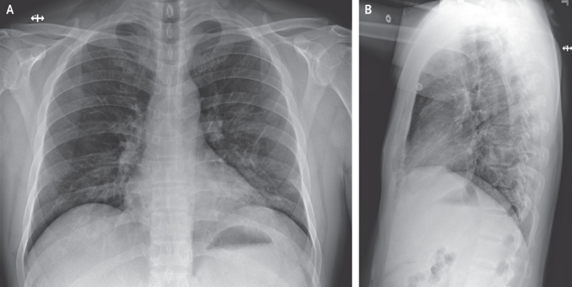 Hình ảnh X quang ngày 10 (hết tổn thương nền phổi 2 bên) [7]