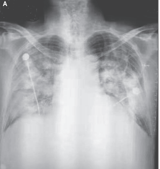 Hình ảnh X quang ngày 9 (tổn thương lưới và đông đặc nền phổi 2 bên) [7]