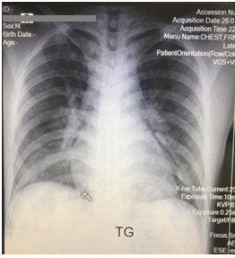Hình ảnh Bệnh nhân P.V.C. kính mờ nửa dưới 2 phổi do 2019-nCoV