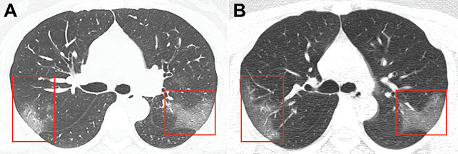 Hình ảnh tổn thương bệnh nhân viêm phổi do 2019- nCoV: A, Tổn thương hình kính mờ ở phân thùy sau thùy trên phổi phải và phân thùy đỉnh dưới của thùy trên phổi trái .B, Sau 3 ngày tổn thương kính mờ tiến triển rộng hơn [10].