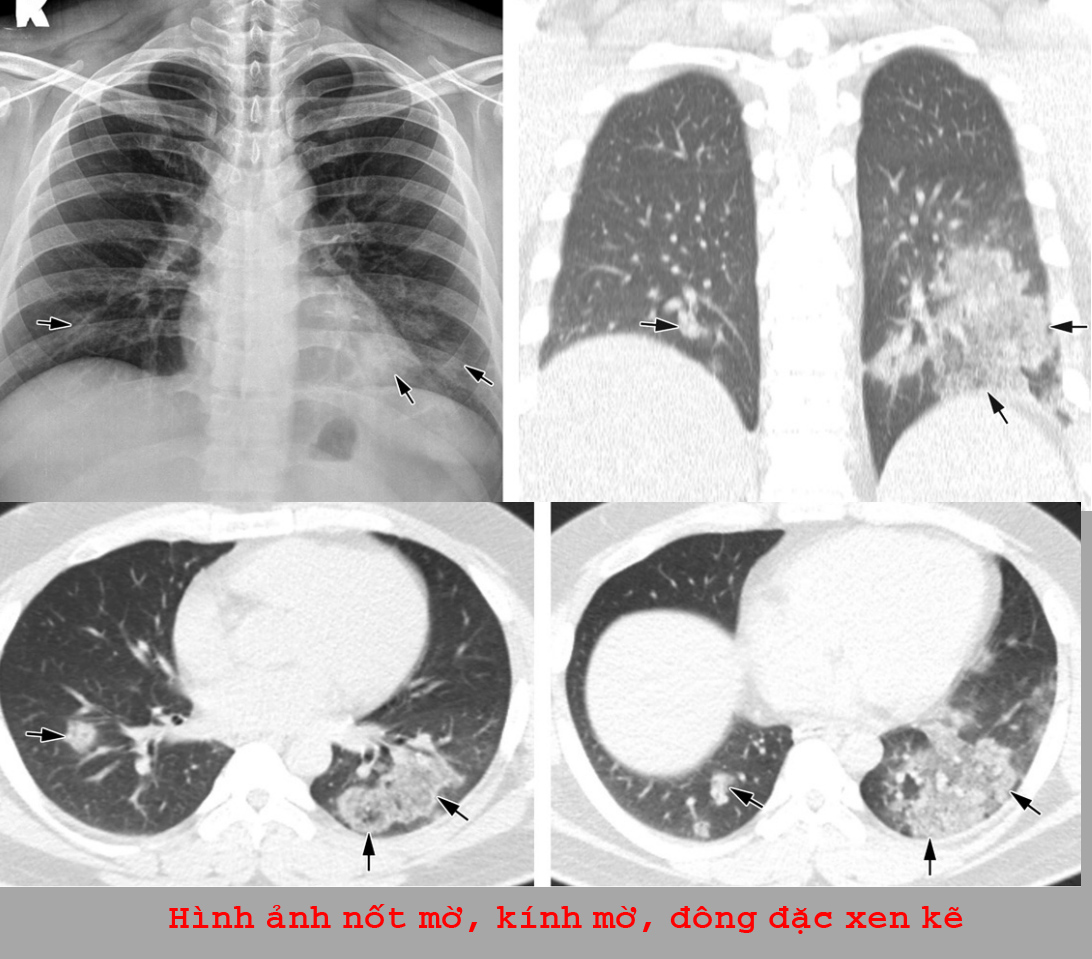 Hình ảnh tổn thương trên xquang quy ước và CLVT của bệnh nhân viêm phổi do MERS corona virus