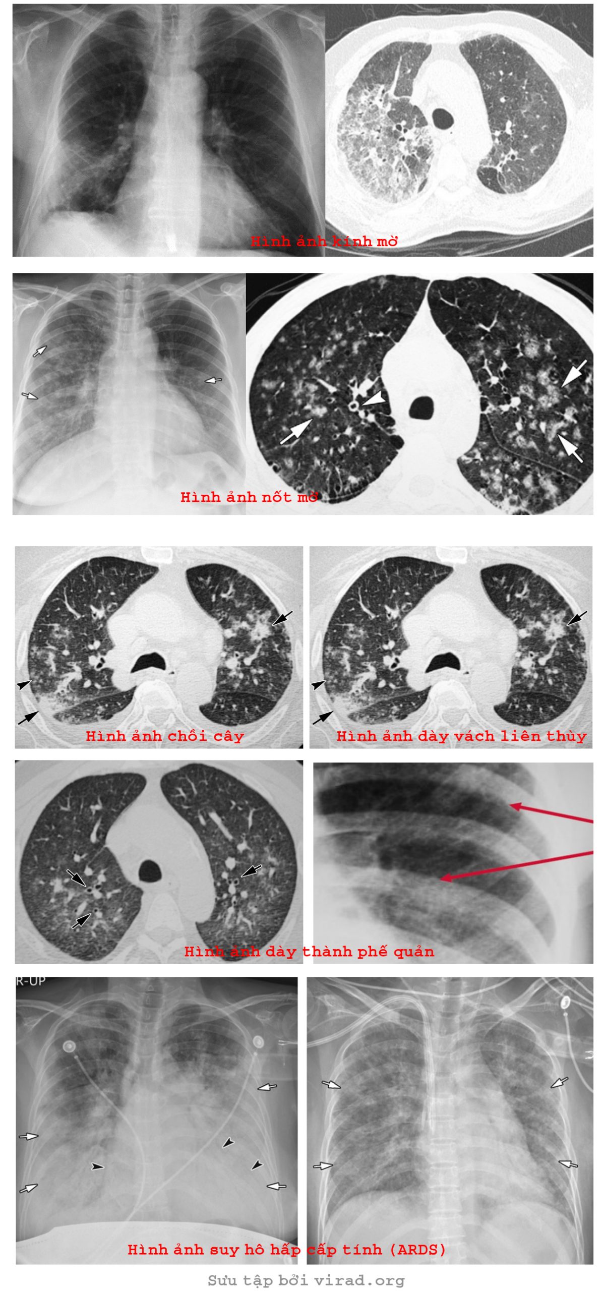 Một số hình ảnh tổn thương của viêm phổi virus