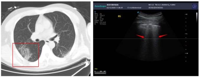 Tìm hiểu hình ảnh siêu âm phổi trên bệnh nhân nhiễm COVID-19