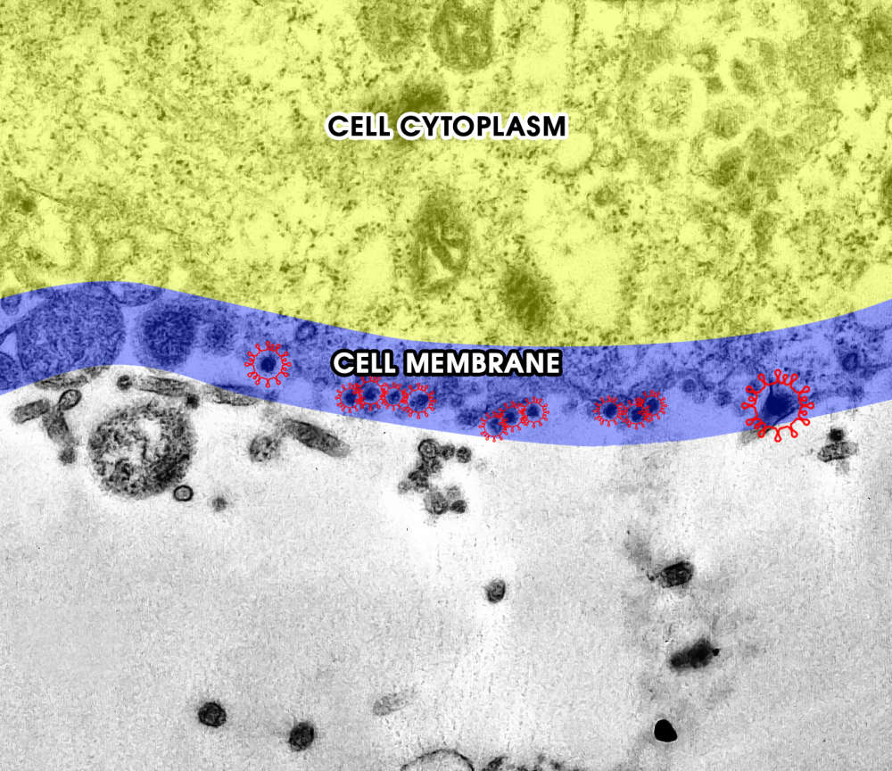 Khoảnh khắc COVID-19 tấn công tế bào khỏe mạnh trên kính hiển vi điện tử