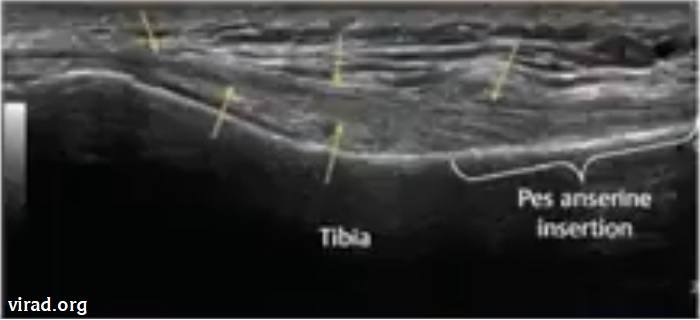 Hình minh họa các lát cắt cơ bản siêu âm khớp gối – phần 2 mặt trước bên