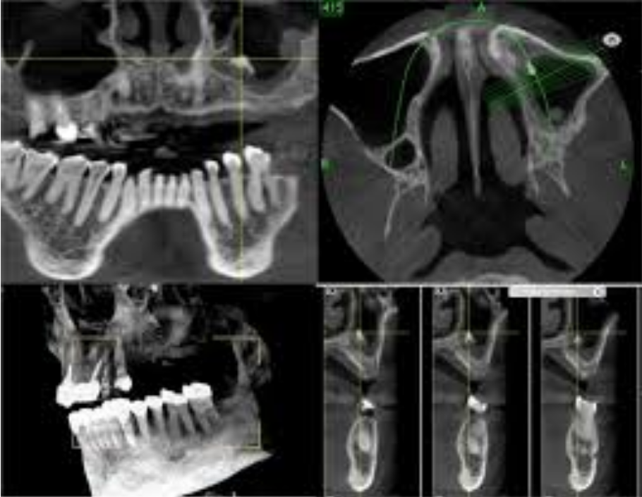 Tại sao cần chụp phim CT Cone Beam khi trồng răng implant